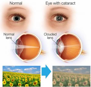 Cataract Cloudy Vision