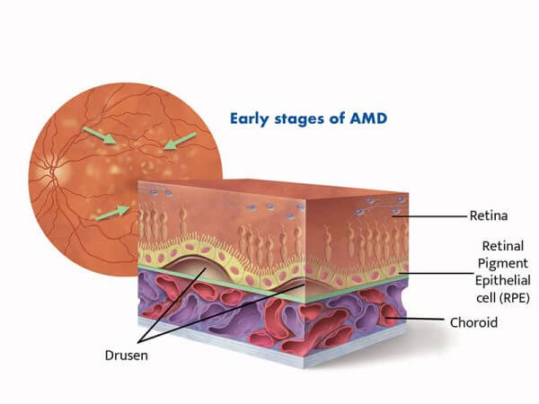 Early-stages-of-AMD